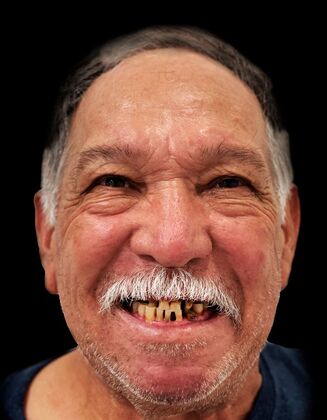 Dental Implants: Hilario- Total Fixed Prosthesis - After