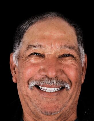 Dental Implants: Hilario- Total Fixed Prosthesis - Before