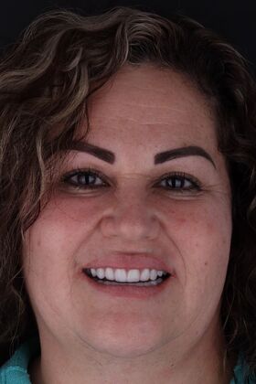 Dental Implants: Silvia - Fixed Hybrid denture - After