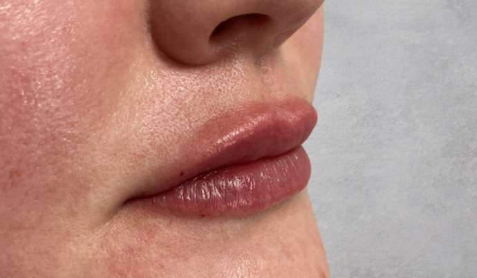 Filler - Lips Case 22 - After