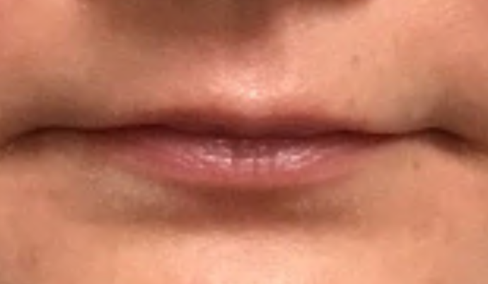 Filler - Lips: Case 22 - Before