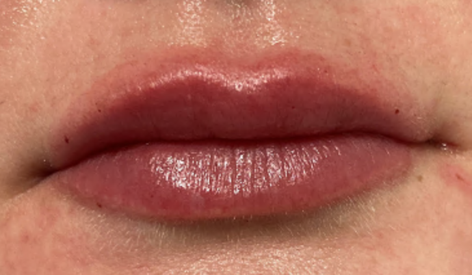 Filler - Lips: Case 22 - After
