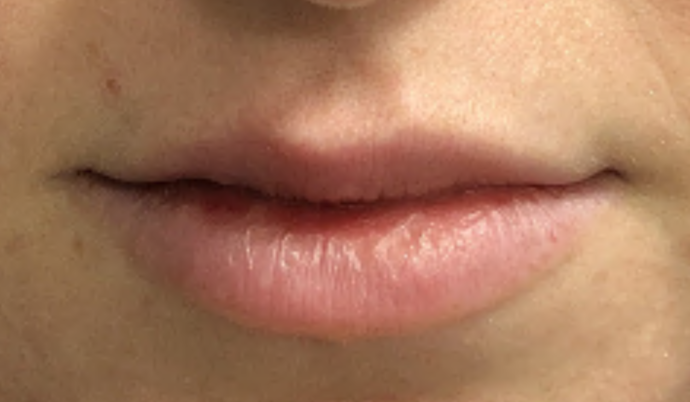 Filler - Lips Case 23 - Before