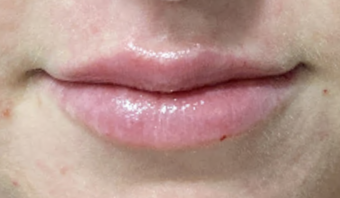 Filler - Lips Case 23 - After