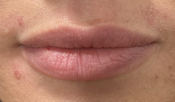 Filler - Lips Case 24 - Before