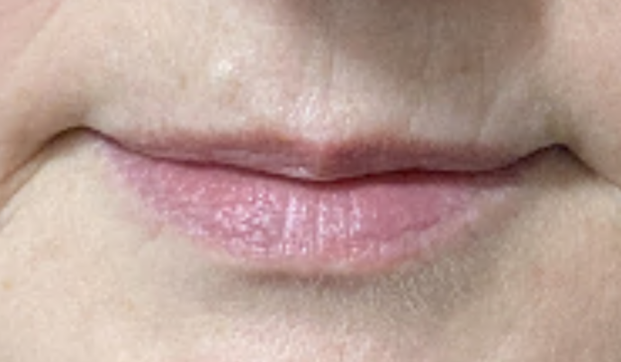 Filler - Lips Case 25 - Before
