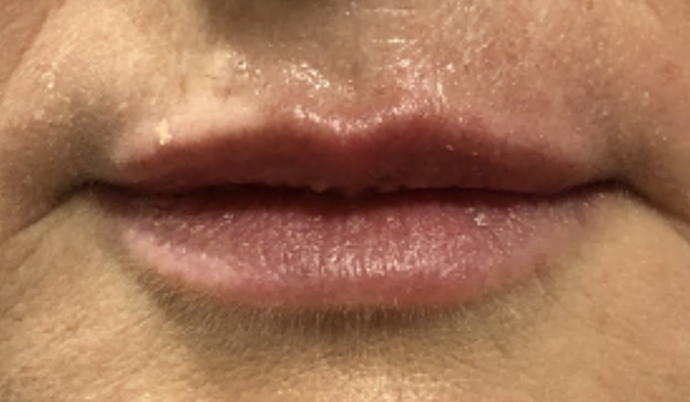 Filler - Lips Case 25 - After