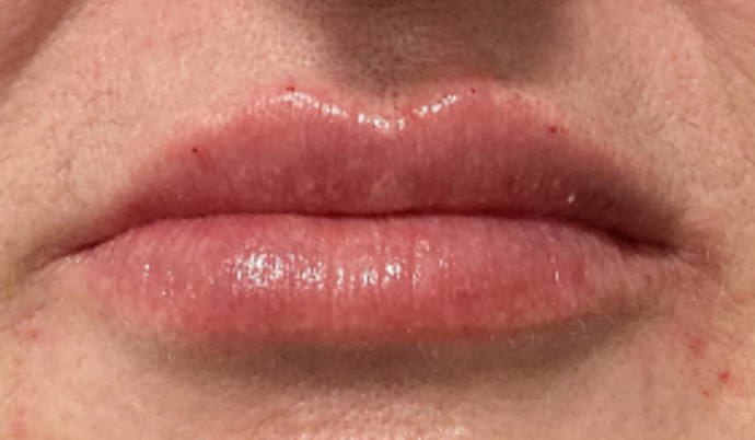 Filler - Lips Case 26 - After