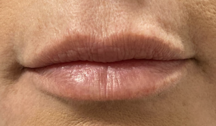 Filler - Lips Case 27 - Before