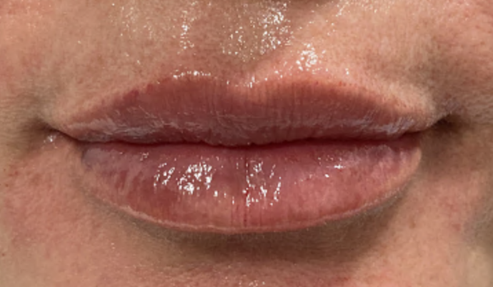 Filler - Lips Case 27 - After
