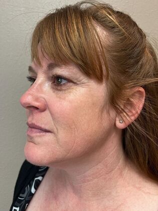 Laser Skin Resurfacing*: IPL - After