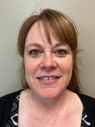 Laser Skin Resurfacing*: IPL - After