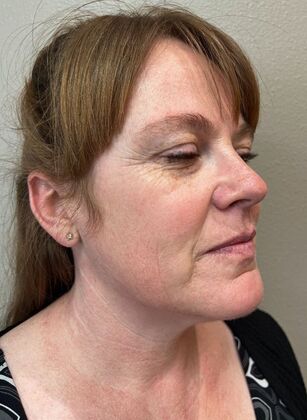 Laser Skin Resurfacing*: IPL - After