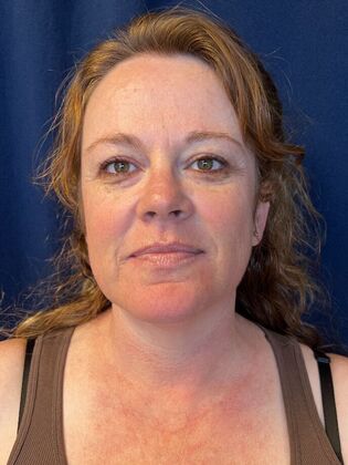 Laser Skin Resurfacing*: IPL - Before