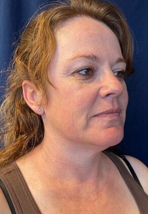 Laser Skin Resurfacing*: IPL - Before