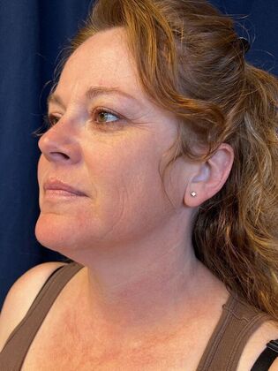 Laser Skin Resurfacing*: IPL - Before