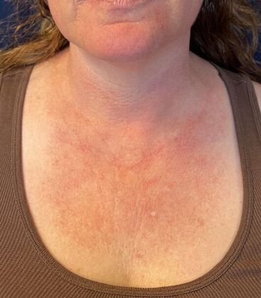 Laser Skin Resurfacing*: IPL - Before