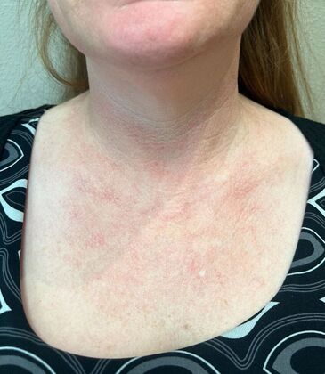 Laser Skin Resurfacing*: IPL - After