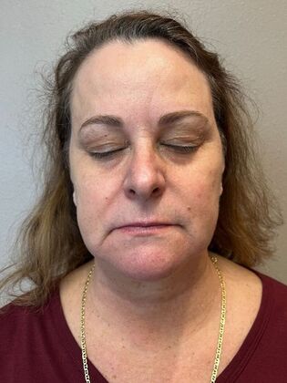 Laser Skin Resurfacing*: IPL 2 - After