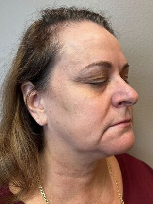 Laser Skin Resurfacing*: IPL 2 - After