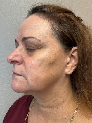 Laser Skin Resurfacing*: IPL 2 - After