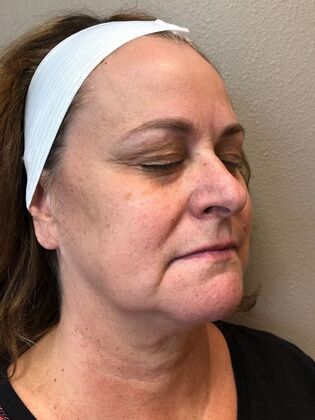 Laser Skin Resurfacing*: IPL 2 - Before