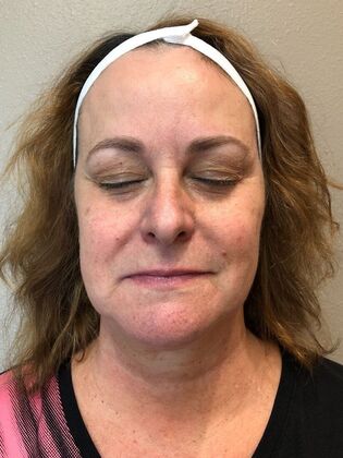 Laser Skin Resurfacing*: IPL 2 - Before