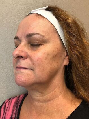 Laser Skin Resurfacing*: IPL 2 - Before