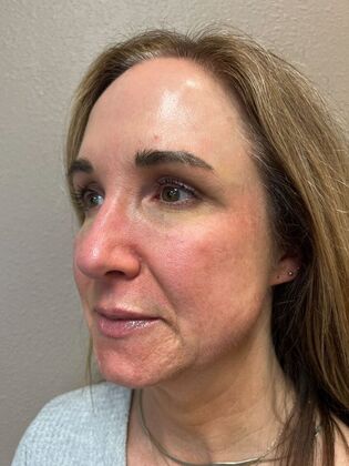 Laser Skin Resurfacing*: Combo Laser Therapy - After