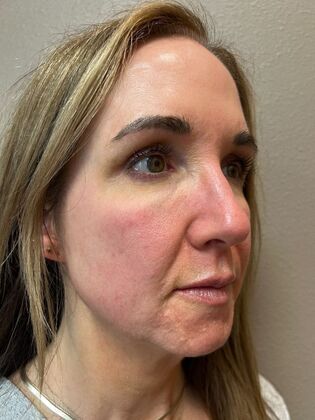 Laser Skin Resurfacing*: Combo Laser Therapy - After