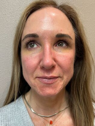 Laser Skin Resurfacing*: Combo Laser Therapy - After
