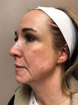 Laser Skin Resurfacing*: Combo Laser Therapy - Before