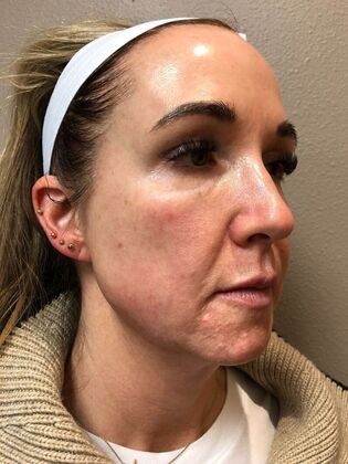 Laser Skin Resurfacing*: Combo Laser Therapy - Before