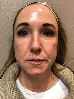 Laser Skin Resurfacing*: Combo Laser Therapy - Before