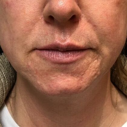 Laser Skin Resurfacing*: Combo Laser Therapy - Before