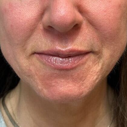 Laser Skin Resurfacing*: Combo Laser Therapy - After