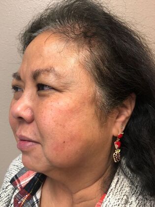 Laser Skin Resurfacing*: Picosure Facial 1 - After