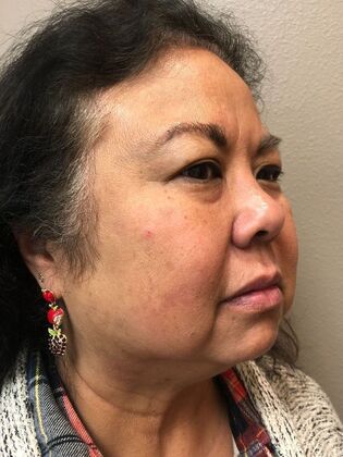 Laser Skin Resurfacing*: Picosure Facial 1 - Before