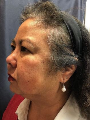 Laser Skin Resurfacing*: Picosure Facial 1 - Before