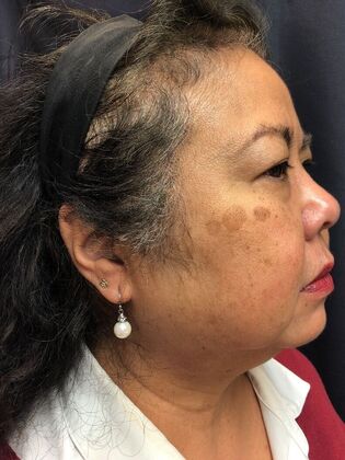 Laser Skin Resurfacing*: Picosure Facial 1 - After