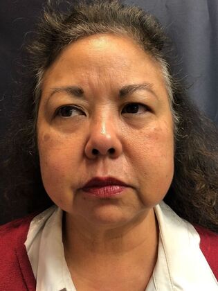 Laser Skin Resurfacing*: Picosure Facial 1 - After