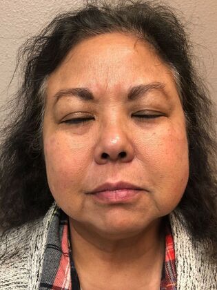 Laser Skin Resurfacing*: Picosure Facial 1 - Before