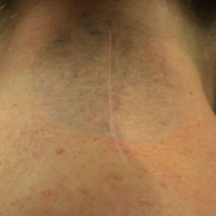 Tattoo Removal : Tattoo Removal 4 - After