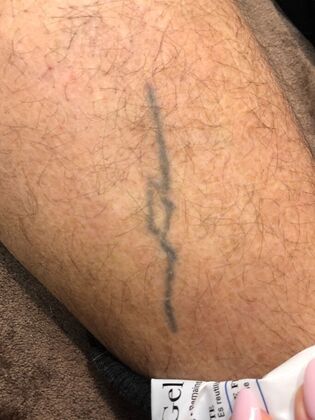 Tattoo Removal : Tattoo Removal 13 - After
