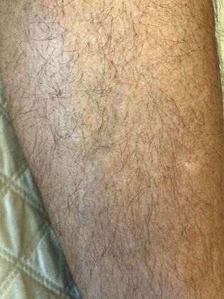 Tattoo Removal : Tattoo Removal 13 - Before