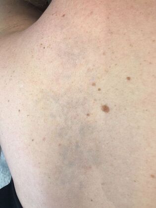 Tattoo Removal : Tattoo Removal 3 - After