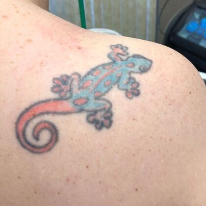 Tattoo Removal : Tattoo Removal 5 - Before