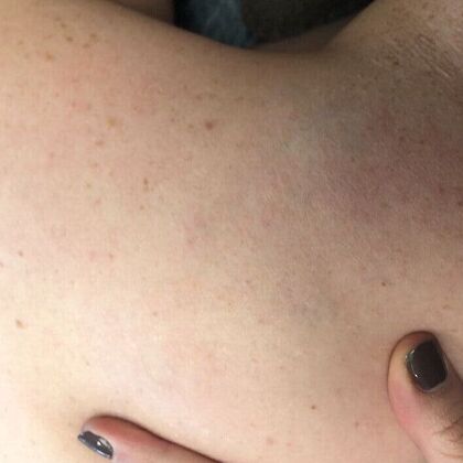 Tattoo Removal : Tattoo Removal 5 - After