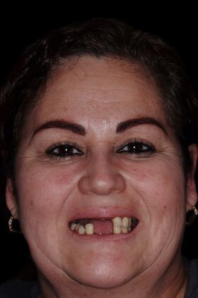 Dental Implants: Silvia - Fixed Hybrid denture - Before