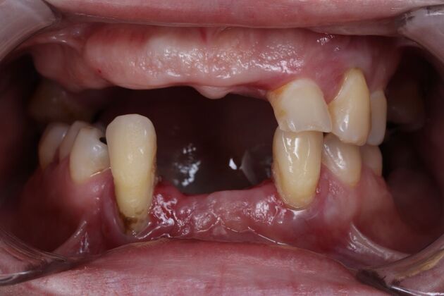 Dental Implants: Silvia - Fixed Hybrid denture - Before